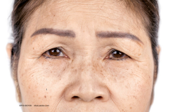 Older age, high BMI are risks for blepharoptosis in Korean patients