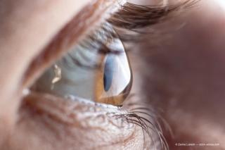 Study: IOL calculation remains challenging in PKP eyes