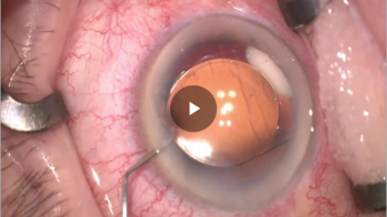 The capsular bag: A new site for drug delivery
