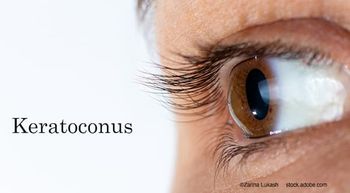 (Image credit: AdobeStock/Zarina Lukash) Novel therapy for incision-free keratoconus: Q&A with Gloria B. Chiu, OD, FAAO, FSLS