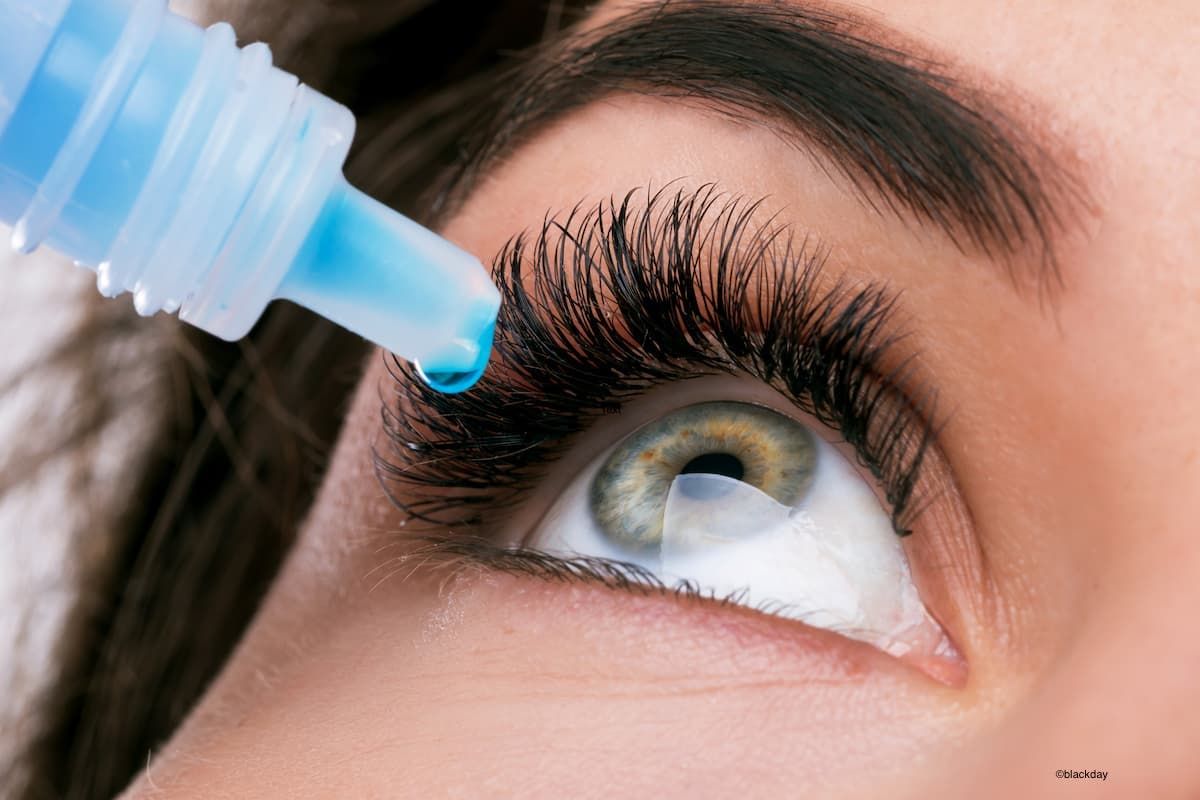 close up image of a woman dropping eye drops into her eye