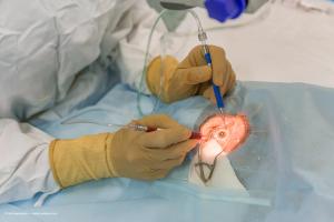 Cataract surgery pearls for cases with poor mydriasis, zonules