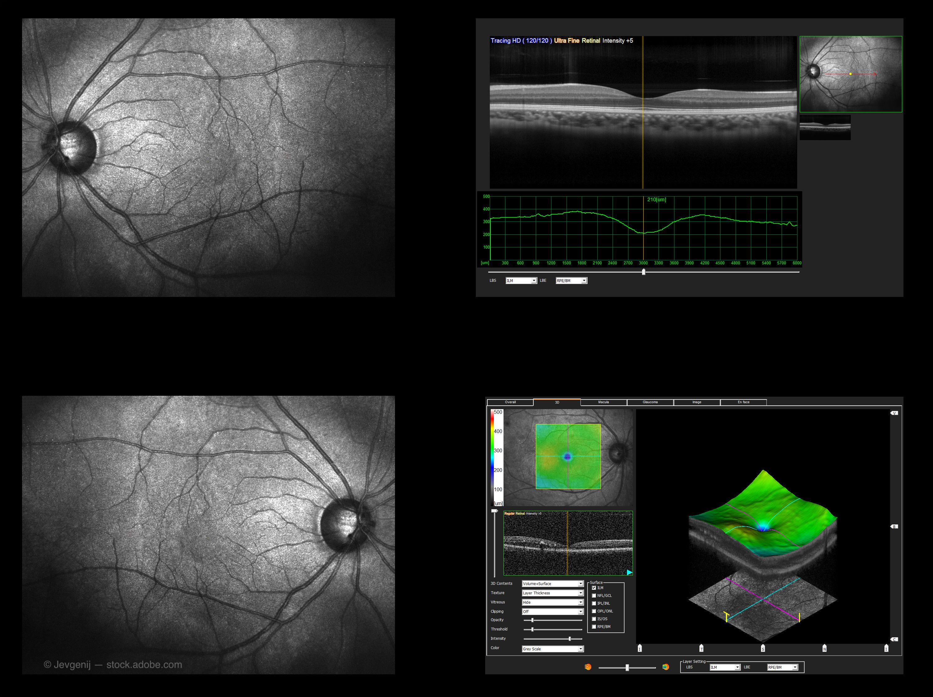 Choroidal hypertransmission defects on en face OCT imaging predict geographic atrophy in patients