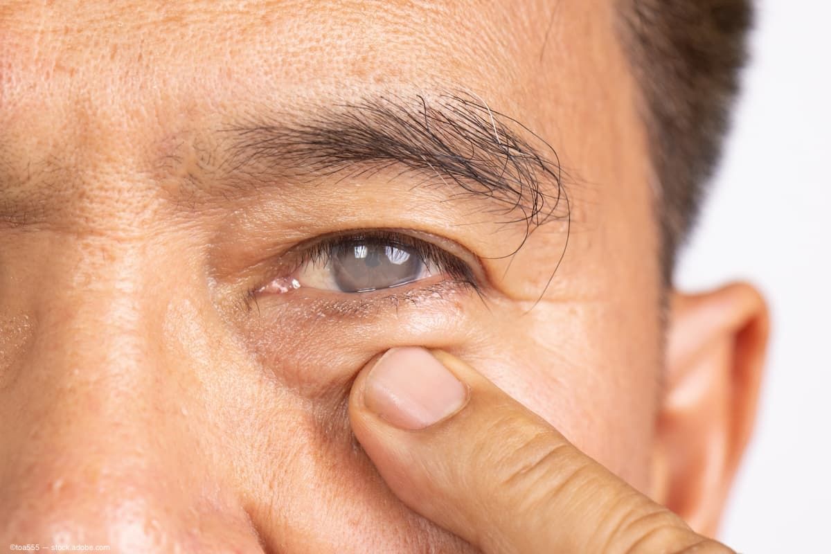 New World Medical launches non-valved glaucoma drainage device, Ahmed ClearPath ST