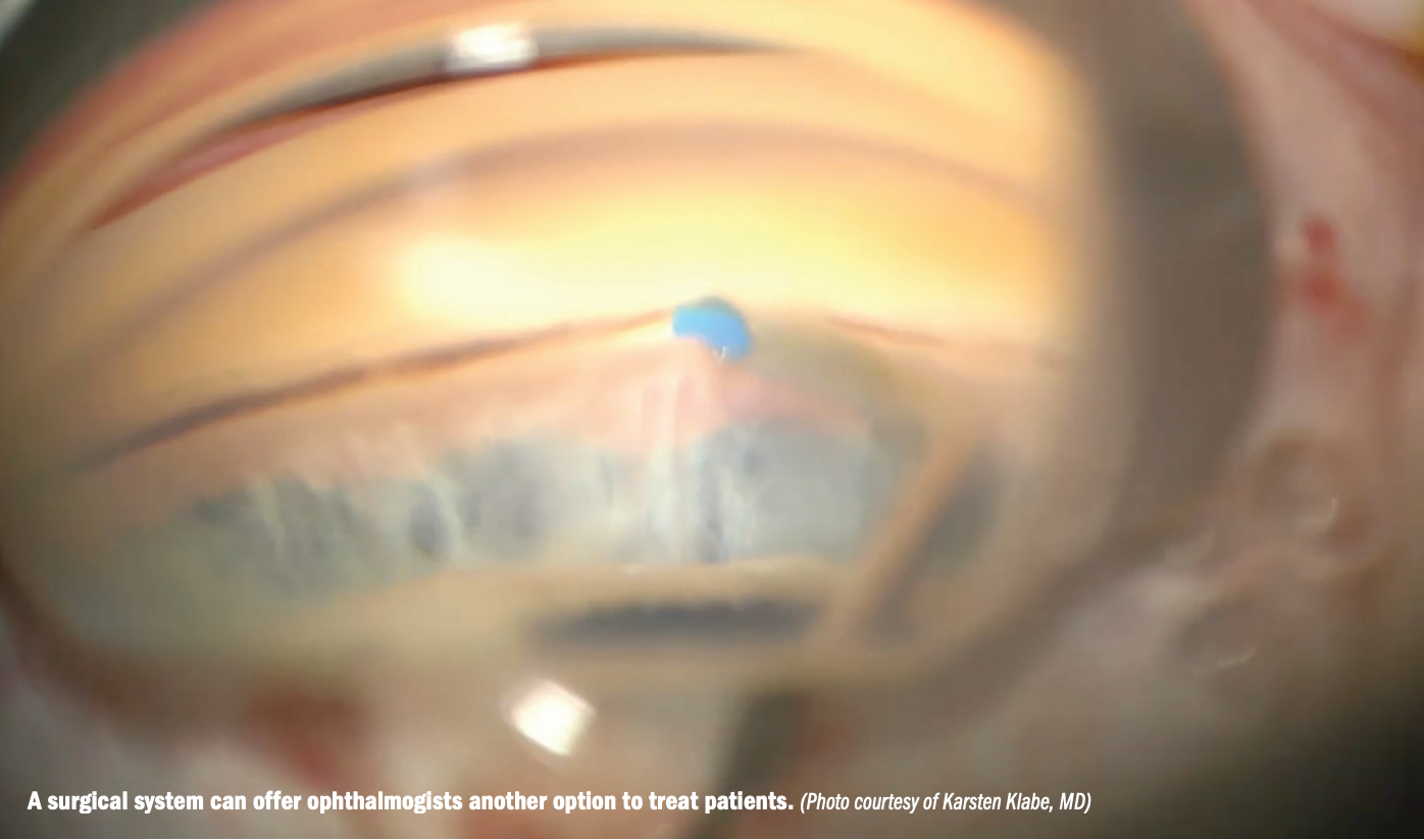 A surgical system can offer ophthalmogists another option to treat patients. 