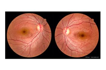 FAF shedding light on patterns related to disease chronicity in CSC