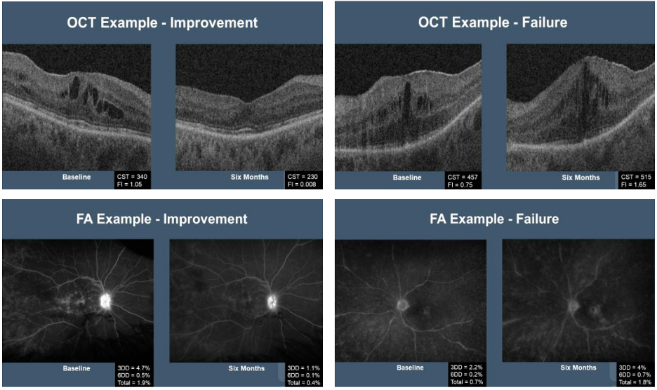 Examples of Improvement and Failure Following Treatment with Fluocinolone Intravitreal Implant on OCT (top row) and FA (bottom row) (Images courtesy of Sumit Sharma, MD)