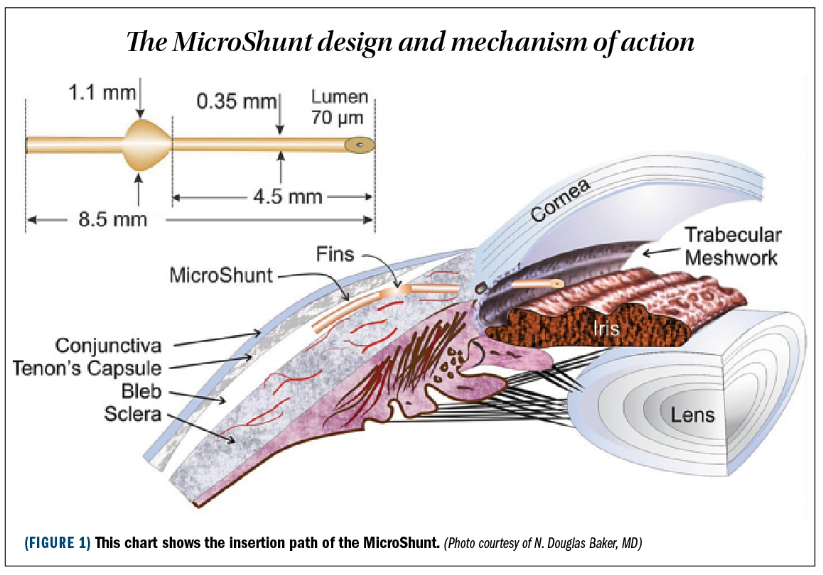 The MicroShunt design and mechanism of action