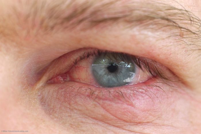 inflammation 6 weeks after cataract surgery