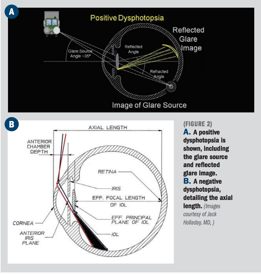 Photopsia Visual Example Dealing with positive and negative dysphotopsias