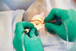 Femtosecond laser-assisted cataract surgery: One physician’s story