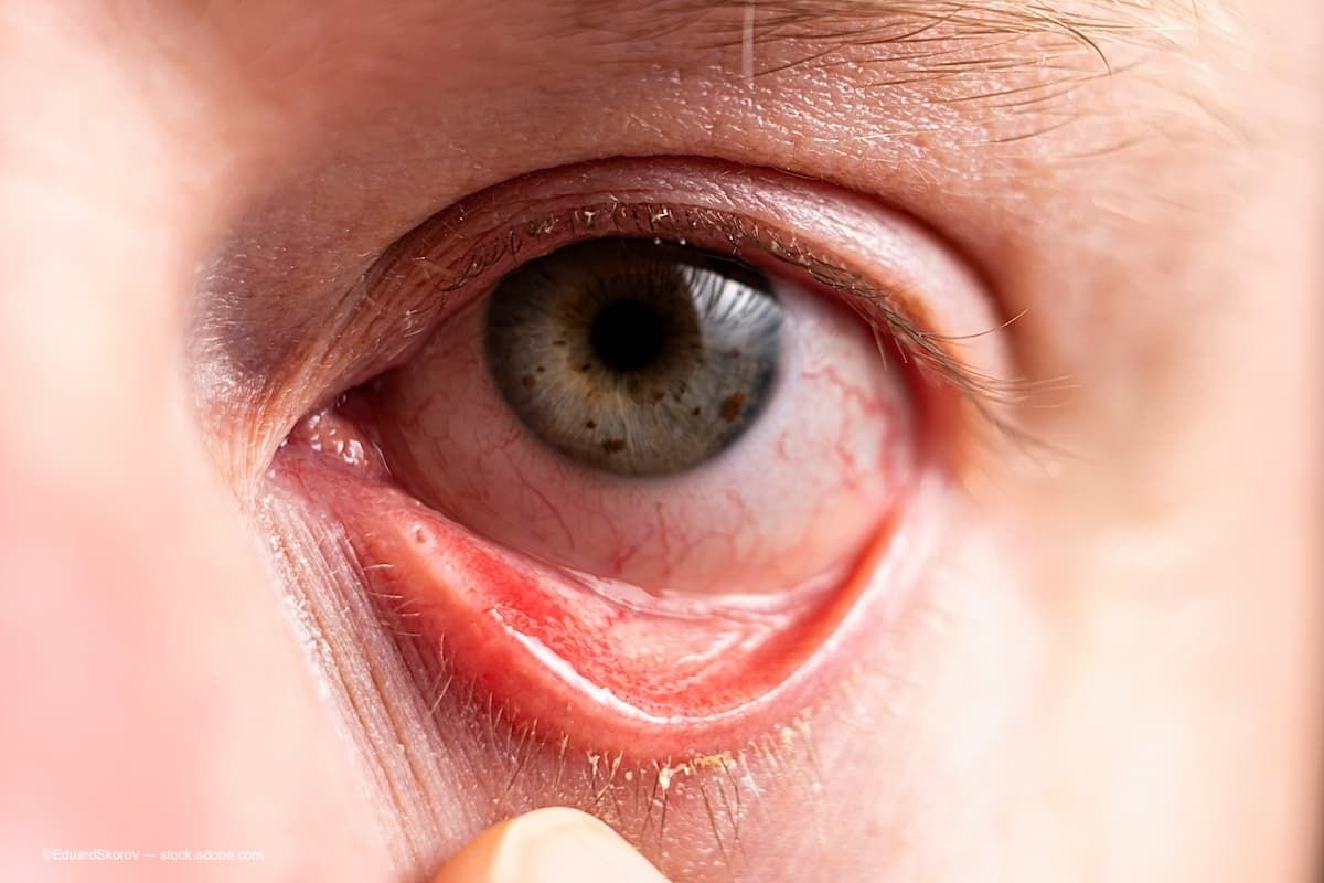 MGD is the most prevalent form of dry eye, present in 86% of dry eye cases. (Image Credit: Adobe Stock/EduardSkorov)