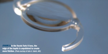 Figure 1: The Tecnis Toric II lens has an edge of the haptic that is unpolished to create more friction