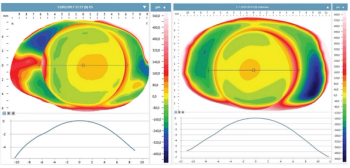 The relationship between myopia and conjunctival-scleral geometry