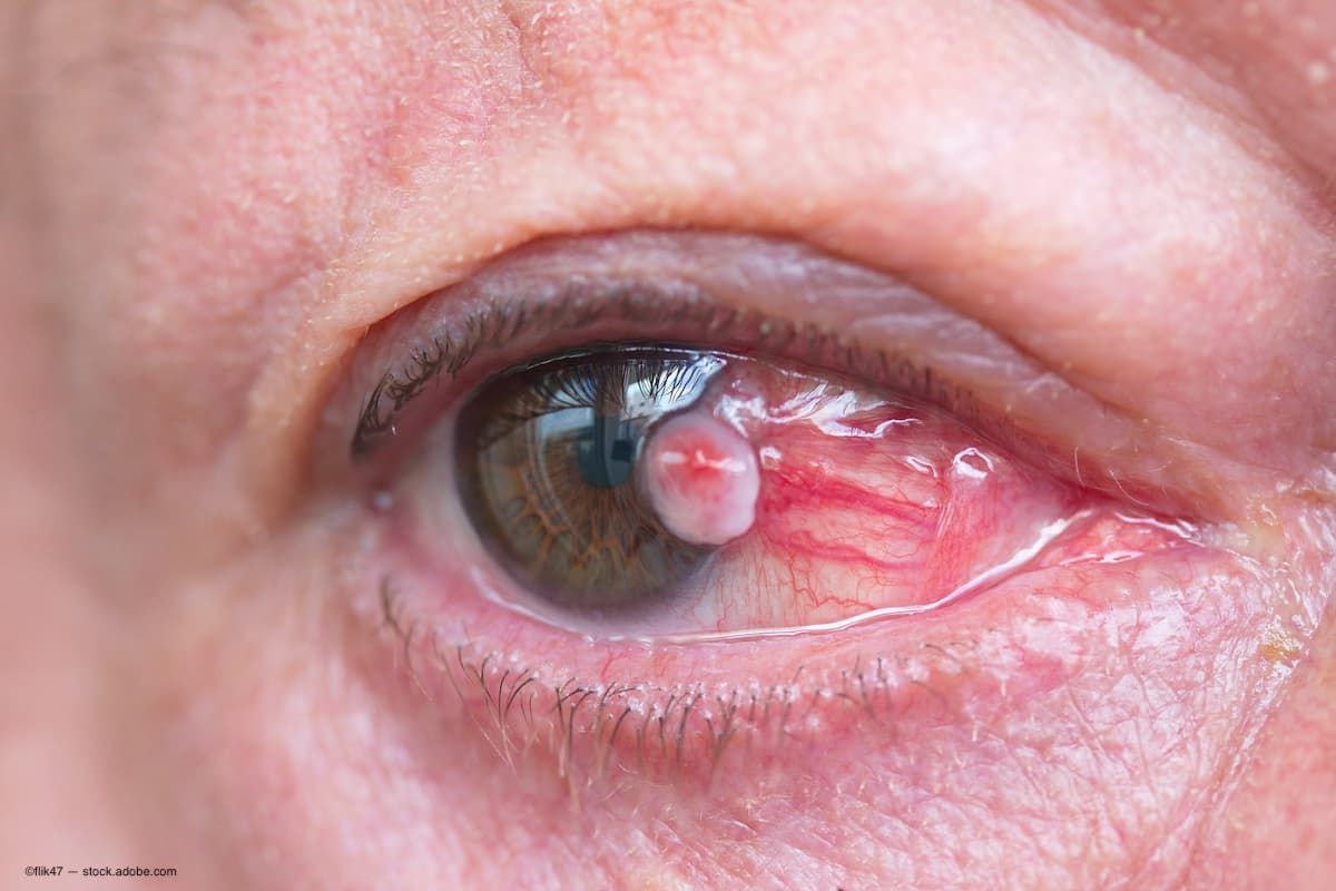 close up of an eye with conjunctival sac on the ocular surface