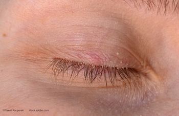 (Image credit: AdobeStock/Paweł Kacperek) Practical strategies: Managing Demodex blepharitis in surgical patients for ocular surface optimization