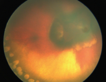 Several innovations are revolutionizing surgical care in pediatric ophthalmology, according to Janet L. Alexander, MD.