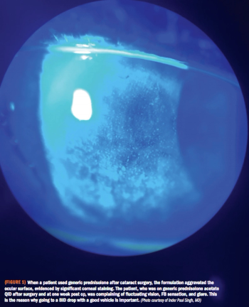Significant corneal staining aggravated a patient's ocular surface post-surgery