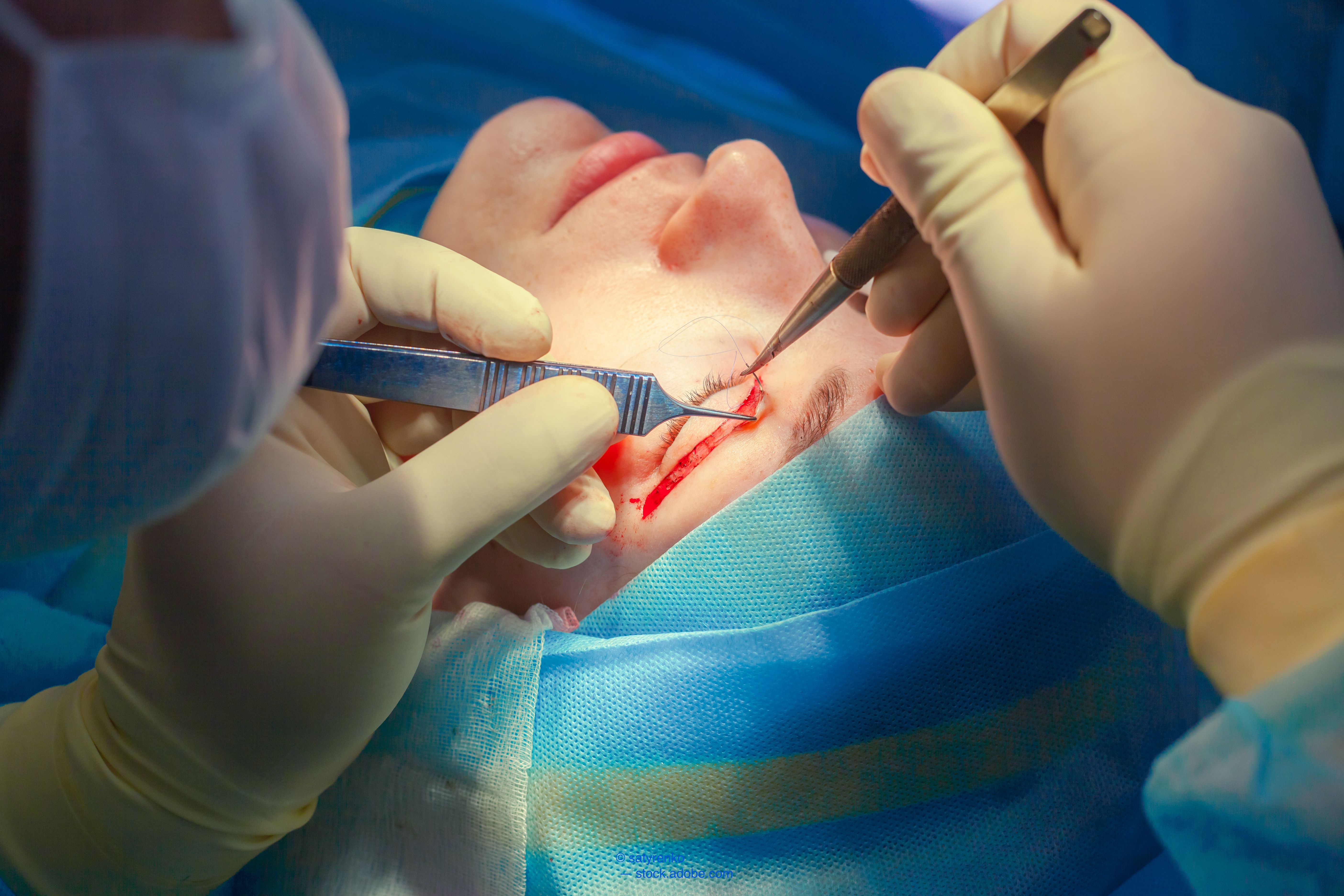 Researchers led by Liza Cohen, MD, from the Division of Orbital and Ophthalmic Plastic Surgery, Stein Eye Institute, Doheny Eye Institute, Los Angeles, reported that development of involutional ptosis may be a multifactorial process.