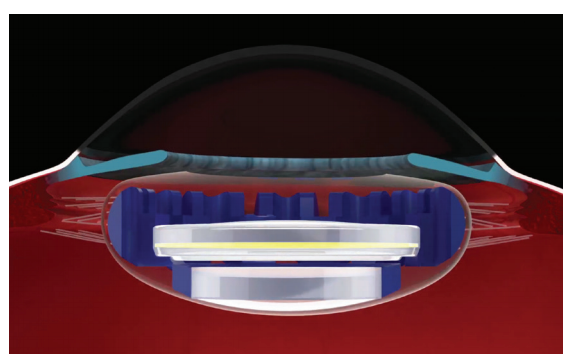 Curvature-changing IOL: New frontier in cataract and presbyopia surgeries