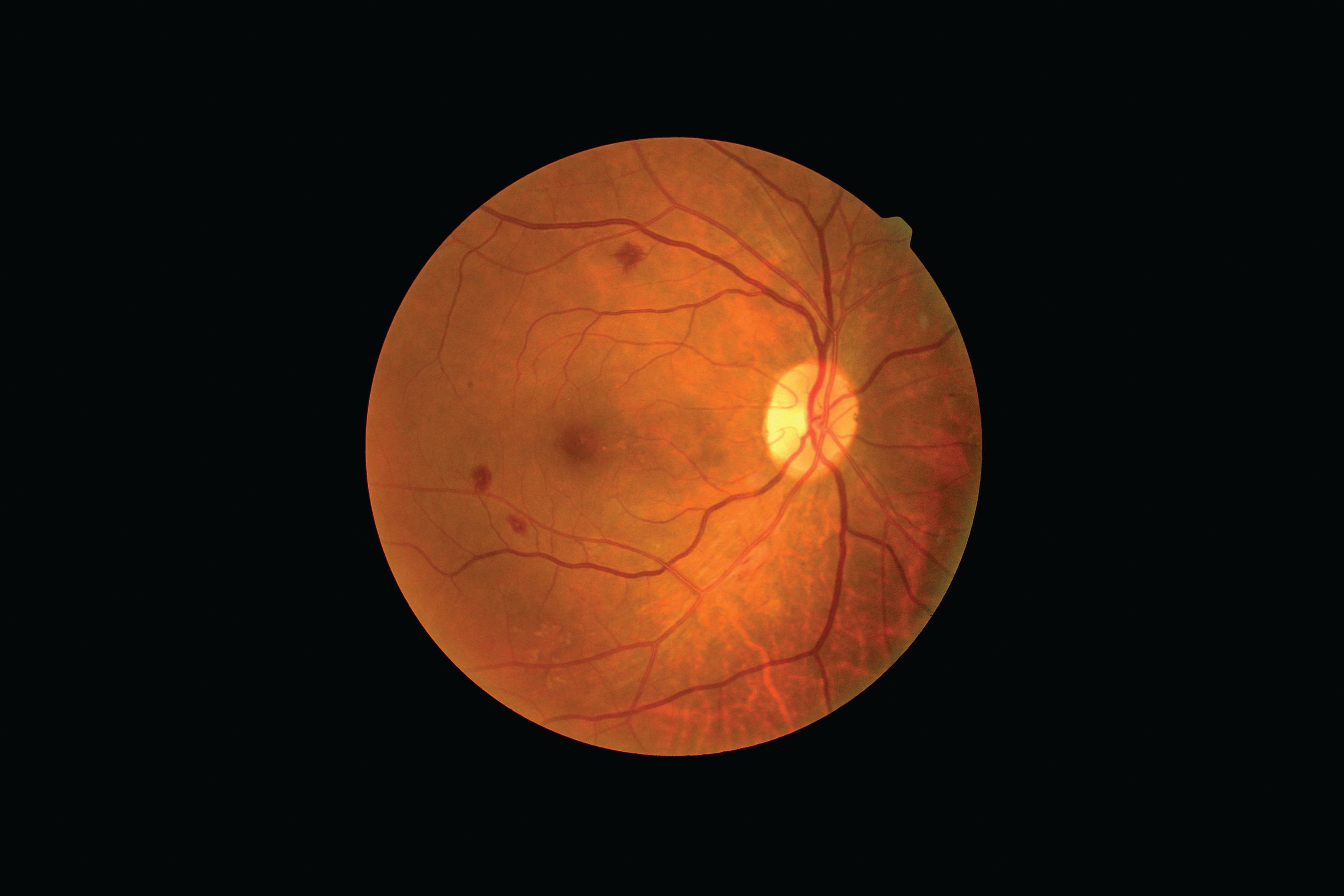 Bariatric surgery was seen to reduce the prevalence of sight-threatening DR by 53%.