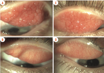 FDA approves cyclosporine A drop for vernal keratoconjunctivitis