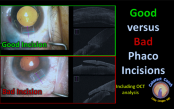 These 3 things are part of a cataract surgeon's signature