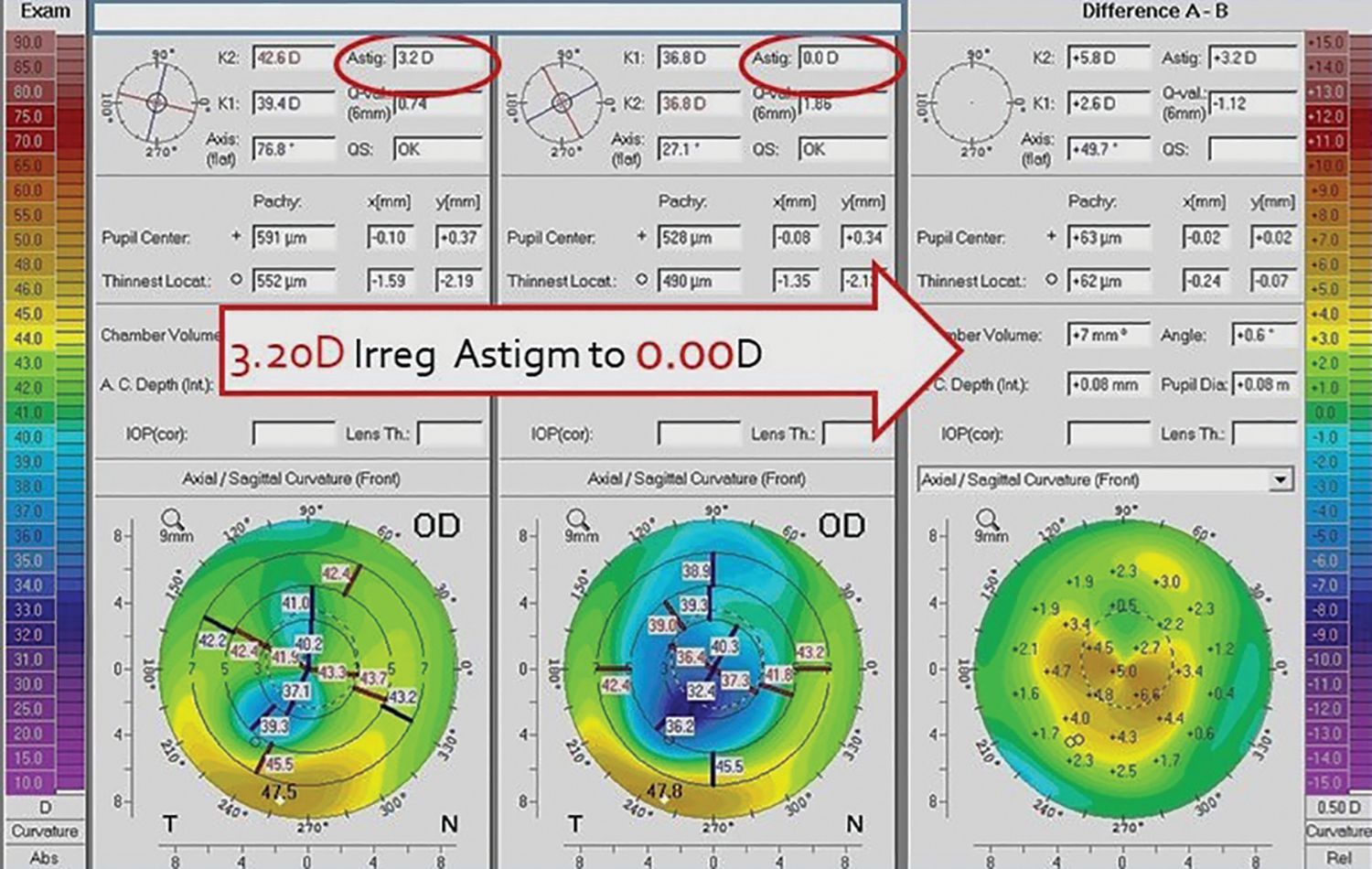Keratoconus after the LaZrPlastique technique. Keratoconus after the LaZrPlastique technique.