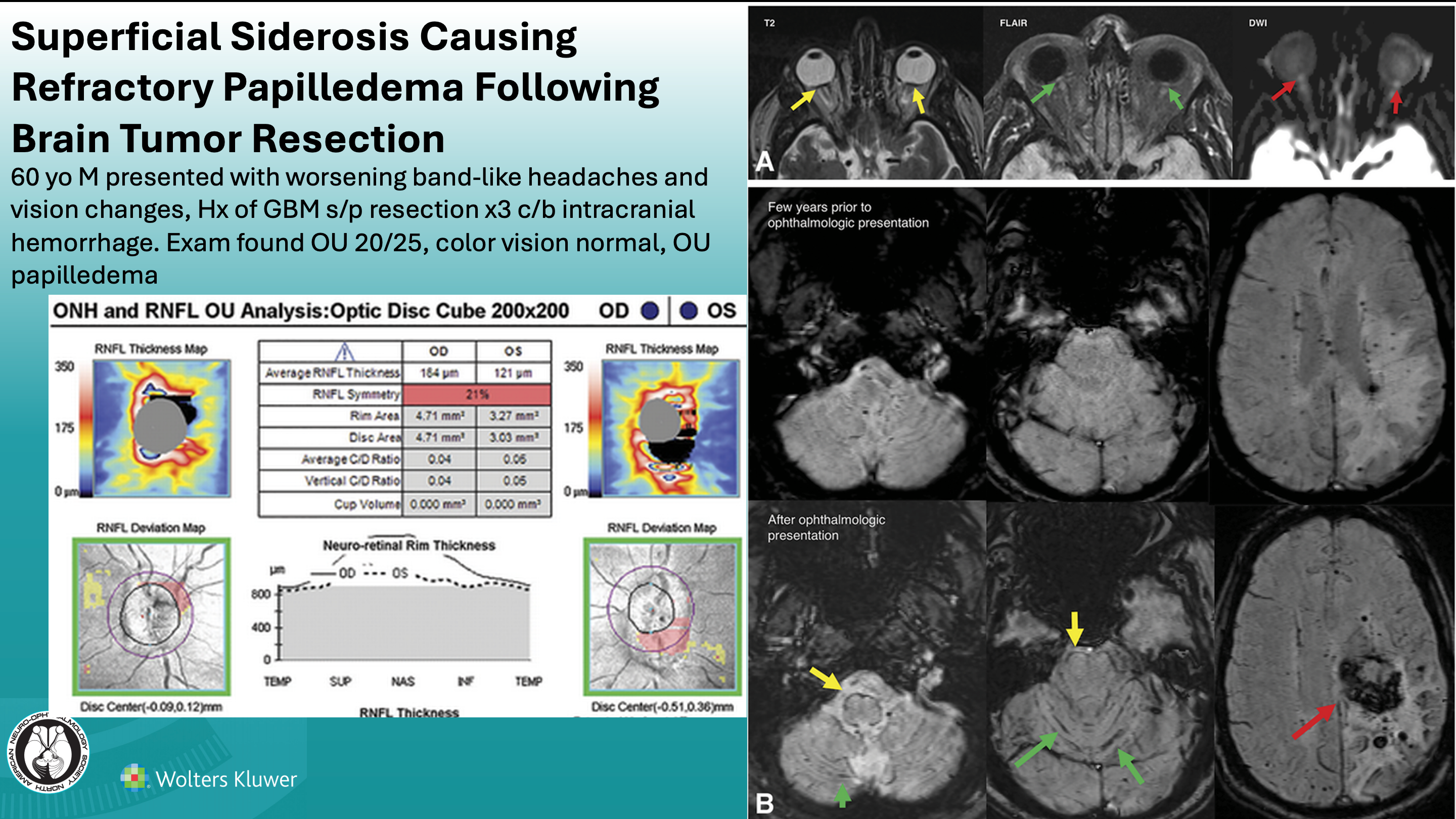 (Image credit: Andrew G. Lee, and Drew Carey, MD) Spiegelman DV, Stunkel L, Goyal MS, et al. Superficial siderosis causing refractory papilledema following brain tumor resection. J Neuroophthalmol. 2025;45(2):e142-e144. doi:10.1097/WNO.0000000000002178 (Image credit: Andrew G. Lee, and Drew Carey, MD) Spiegelman DV, Stunkel L, Goyal MS, et al. Superficial siderosis causing refractory papilledema following brain tumor resection. J Neuroophthalmol. 2025;45(2):e142-e144. doi:10.1097/WNO.0000000000002178