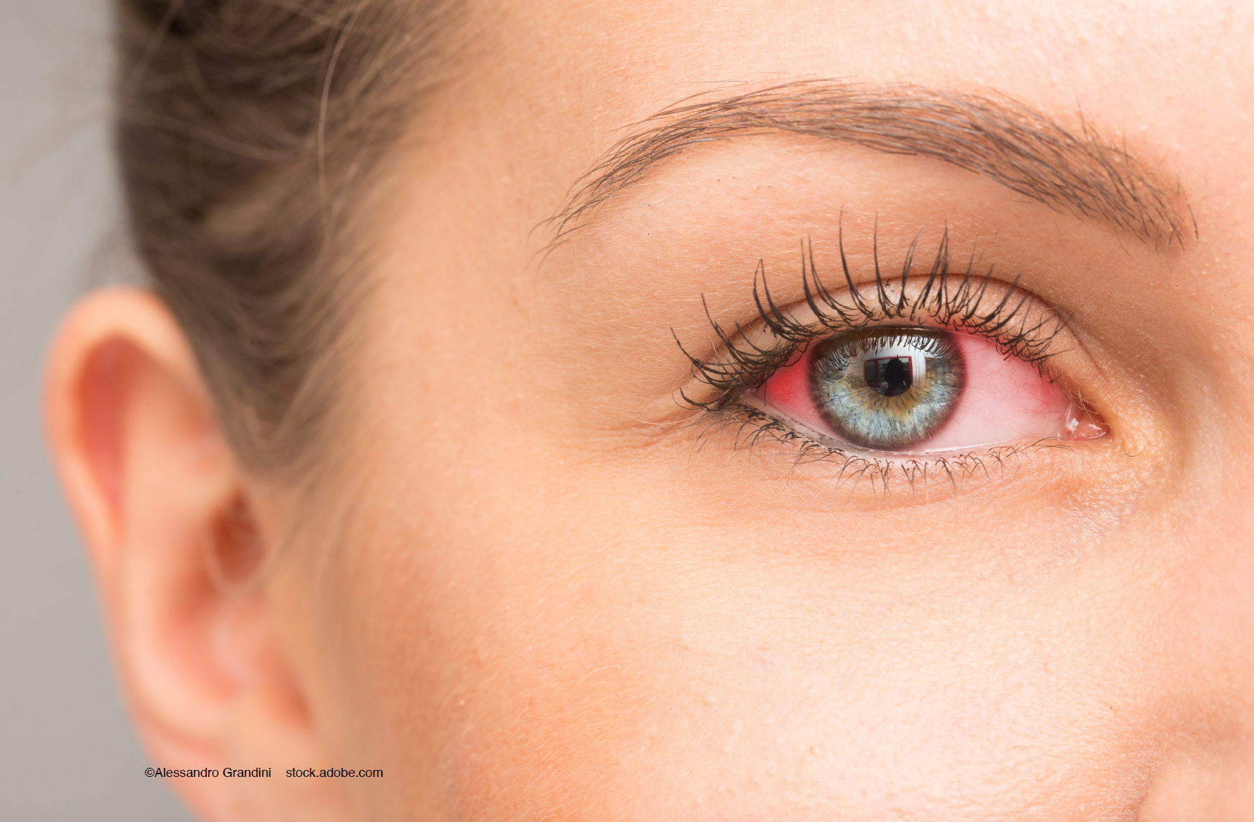 Optineurin: Defending against viral infections of the eye