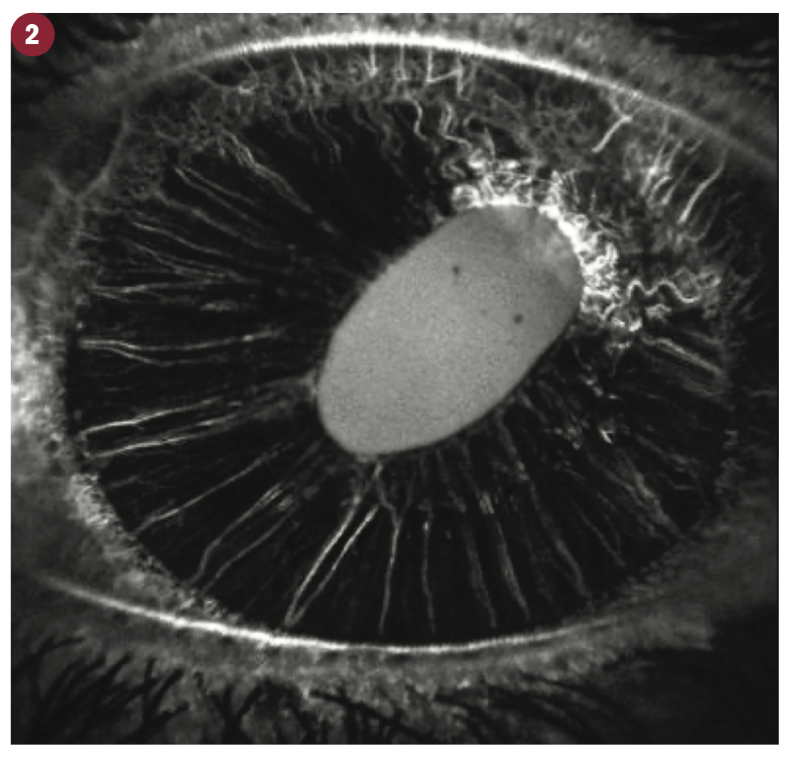 FIGURE 2. Iris fluorescein angiography demonstrating delayed filling and neovascularization of
the superotemporal iris 3 weeks after muscle surgery on the left eye.