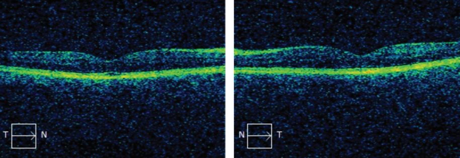 Investigators find value in screening for macular disease in preoperative evaluation