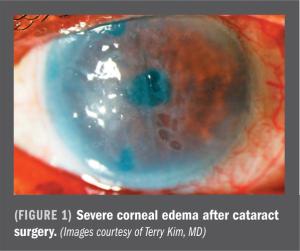 Considering BID ocular steroid post-cataract surgery
