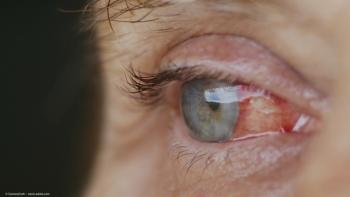 Preop IOP hints after cataract surgery