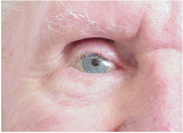 Successful contracted socket rehabilitation