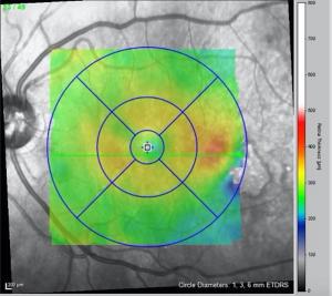 Post-laser treatment