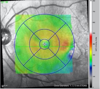 Post-laser treatment