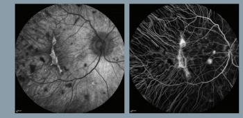 (Figure 1) These images show the remaining island of residual tissue targeted by gene therapy at treatment. The image at left is 1 week after treatment. (Photos courtesy of M. Dominik Fischer, MD, PhD)