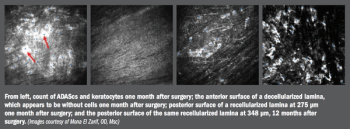 Count of ADASs and keratocytes
