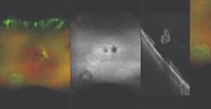 Image may be everything with ultrawidefield-guided swept-source OCT