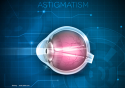Toric IOL implantation: Procedure of choice to correct astigmatism after cataract surgery