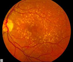 University of Colorado researchers provide evidence linking extracellular vesicles with drusen formation and age-related macular degeneration