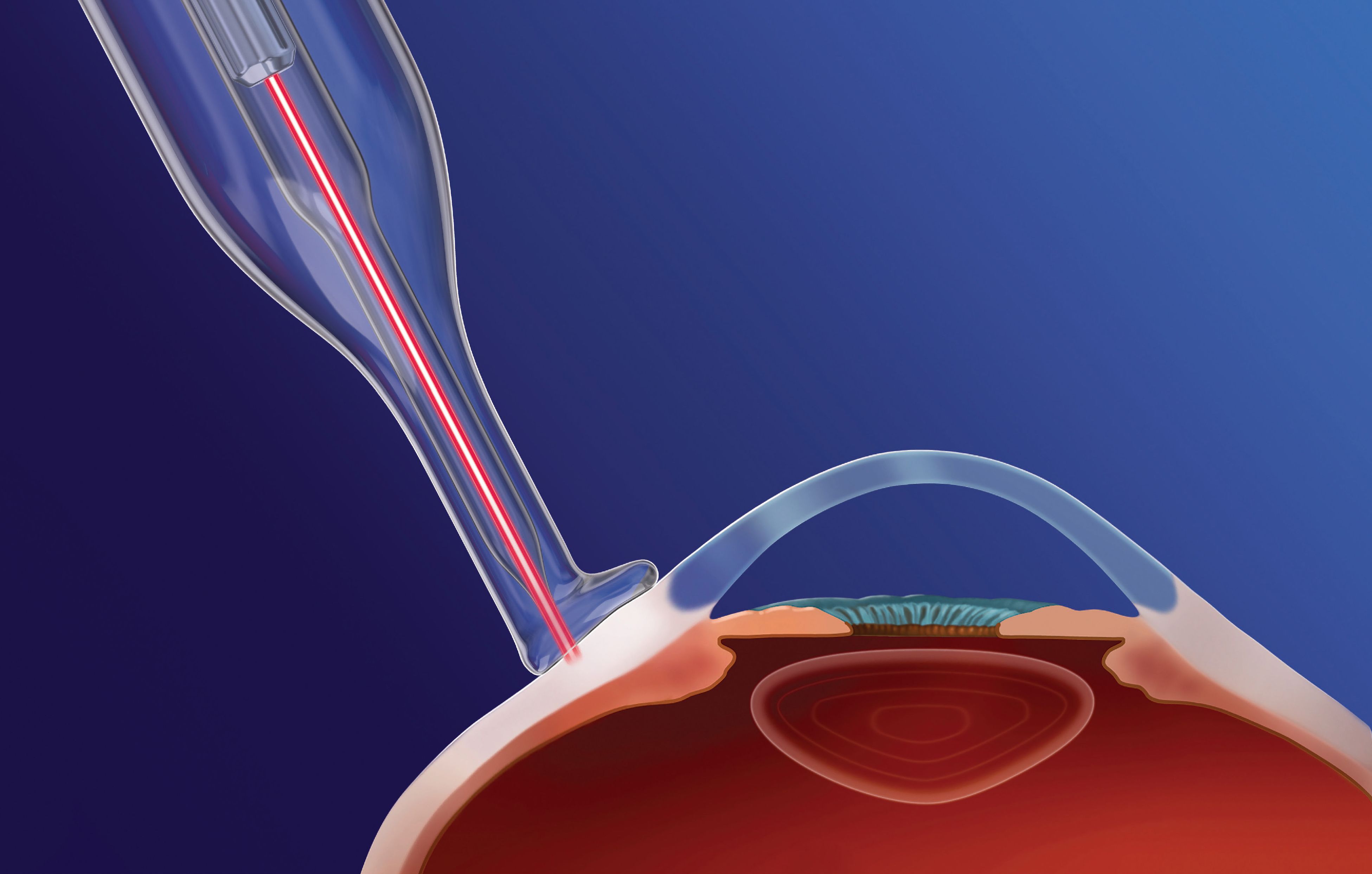 advances in cyclophotocoagulation: good, better, best options