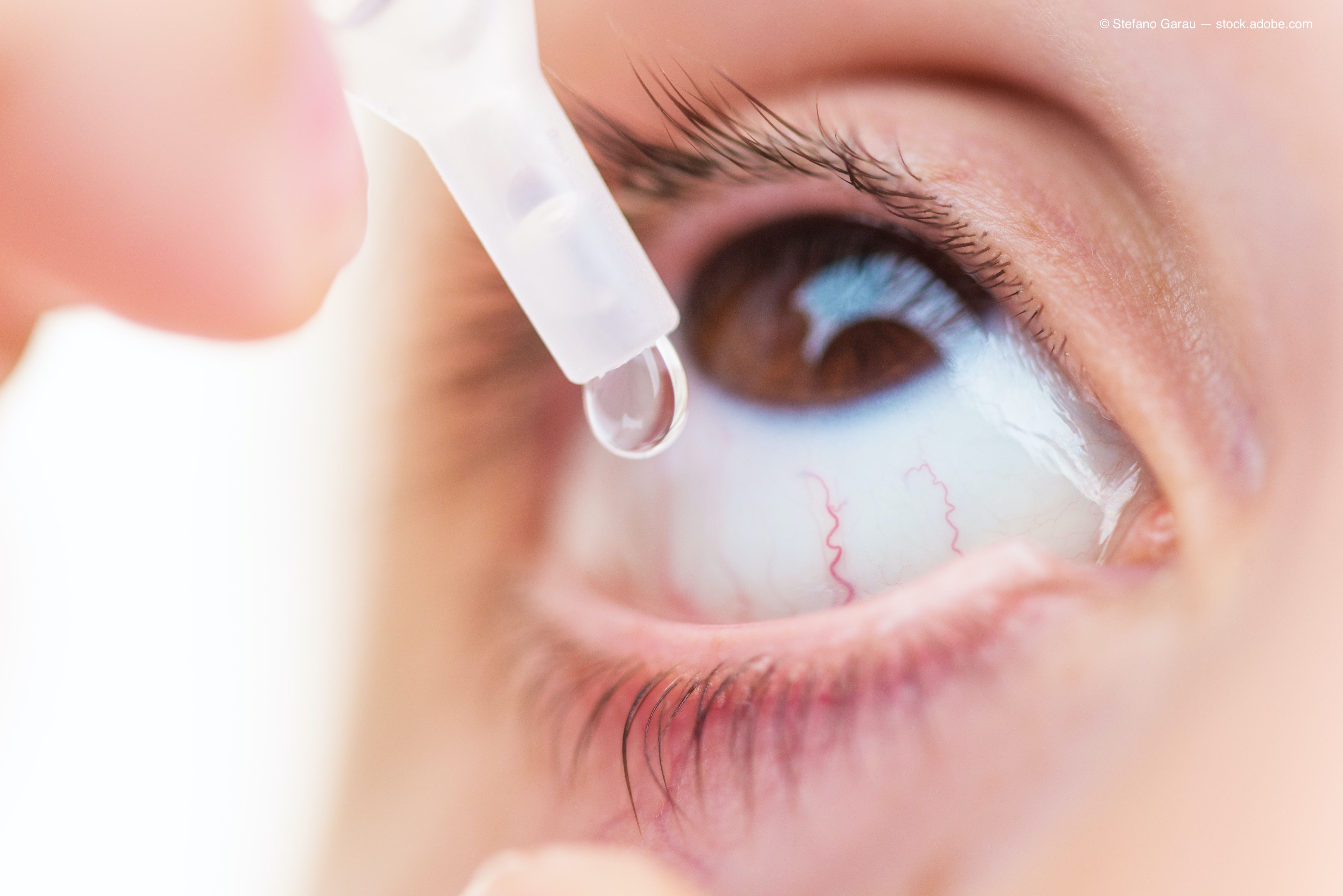 Examining ocular allergy, quality of life