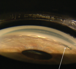 Three cases demonstrate value of new tools, technology for cataract surgeons