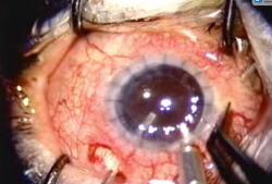 Seize underutilized opportunity to treat glaucoma during vitrectomy