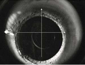 Benefits of topography-guided treatments for irregular corneas