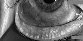 gland atrophy