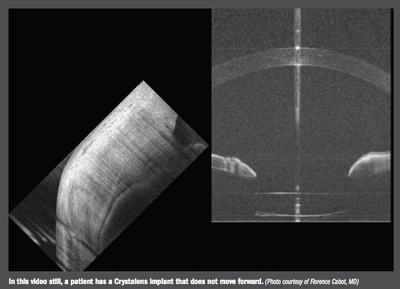 Crystalens implant