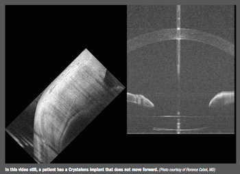 Crystalens implant 